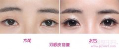 <b>王世勇和韩勋修复双眼皮哪个好</b>
