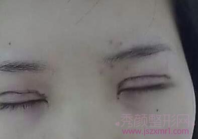 【分享】北京中日友好薛志强双眼皮修复手术