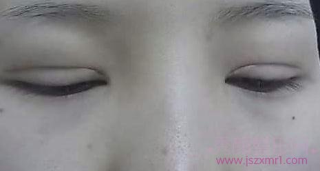 【分享】北京中日友好薛志强双眼皮修复手术