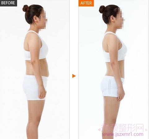 上海华美何斌吸脂怎么样?案例图?
