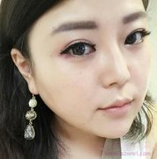 上海百达丽徐晓斐开内眼角第九天