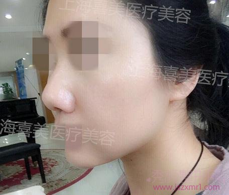 上海喜美缩小鼻头，综合塑形鼻头的案例