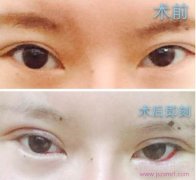 整形分享，双眼皮修复和眼睑下至手术术后20天