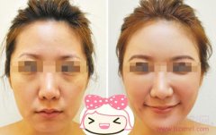 <b>自体脂肪填充一般需要做几次才能长期呢?</b>
