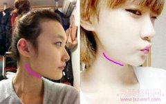 <b>上海九院余东下颌角手术需要多少钱?</b>