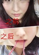 【曝光】上海九院余东磨骨术后分享