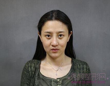 上海华美李健自体脂肪填充怎么样