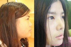<b>上海华美谢卫国和九院李青峰哪个隆鼻好</b>