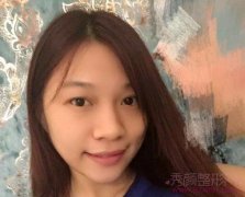 广州鼻部手术隆鼻，两个月恢复分享
