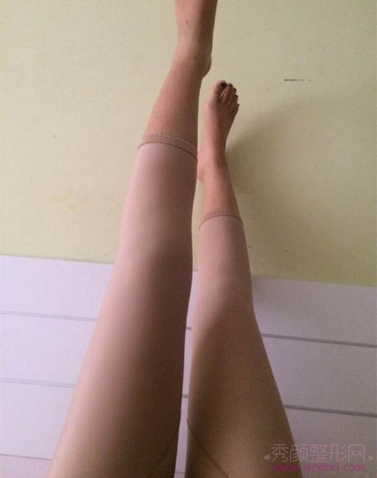 大腿吸脂一个月，恢复的不错哦！