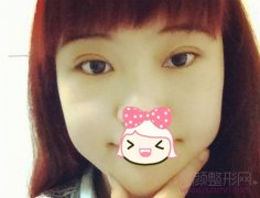 <b>上海九院罗敏做双眼皮怎么样?多少钱?</b>