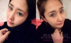 <b>上海九院王涛隆鼻怎么样?</b>