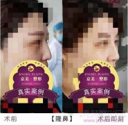 <b>沧州京美提晓华隆鼻怎么样?</b>
