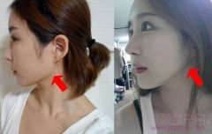 <b>上海九院韦敏和时光何晋龙磨骨哪个好?</b>