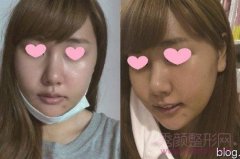 <b>上海华美李志海磨腮削骨改脸型多少钱</b>