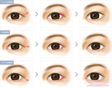 西安西京医院开眼角多少钱?