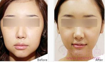 上海仁爱刘庆阳做下颌骨整形怎么样?