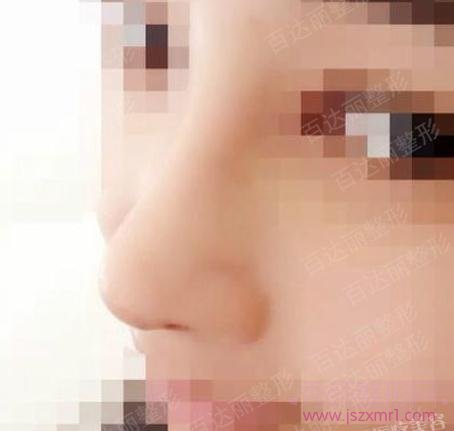 上海百达丽隆鼻哪个医生好?沈国雄还是王艳?