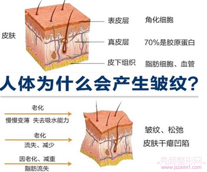 北京电波拉皮除皱大概需要多少钱?