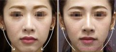 <b>做超声提拉面部提升多少钱一次?</b>