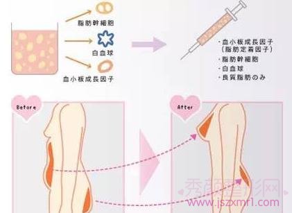 上海九院自体脂肪隆胸多少钱?