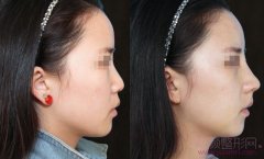 <b>膨体隆鼻的缺点有哪些?</b>