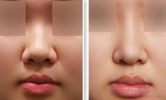 北京八大处鼻部手术整形怎么样?贵吗?