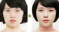 <b>李志海有磨骨失败案例吗?</b>