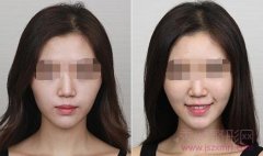 <b>冯斌做自体脂肪填充面部怎么样?</b>