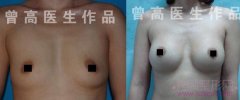 北京中日友好曾高做假体隆胸两个月后对比照片