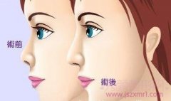 <b>进行二次隆鼻修复手术成功的六大要素</b>