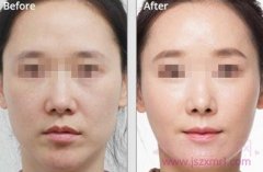 <b>热玛吉、超声提拉和蛋白线提升哪个祛皱果好</b>