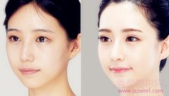 <b>自体脂肪填充是长期的吗?</b>
