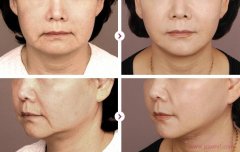 上海九院做热玛吉除皱需要多少钱?