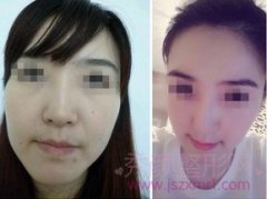 <b>上海民航俞良钢削骨做的好吗?需要多少钱?</b>