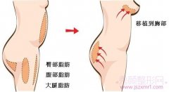 <b>自体脂肪隆胸是长期的吗?能维持多久?</b>