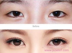 北京八大处王佳琦做双眼皮手术需要多少钱?