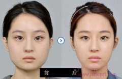 <b>下颌角磨骨术后会有疤痕吗?多久恢复?</b>