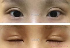 上海百达丽（伯思立）徐晓斐全切修复全纪录