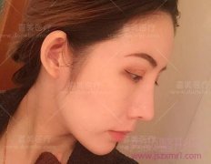 <b>上海喜美王会勇隆鼻、隆鼻修复怎么样?多少钱</b>
