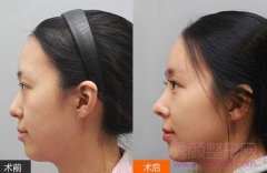 <b>上海鼻部手术整形手术需要多少钱?</b>