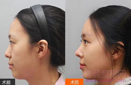 上海鼻部手术整形手术需要多少钱?