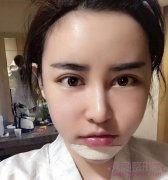做了3D颧骨旋转术,V-Line瓜子脸,我温柔了吗?