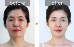 <b>北京做面部提升术大概需要多少钱?</b>