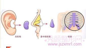 成都铜雀台隆鼻怎么样,多少钱,有案例吗?