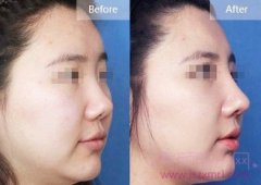 北京米扬丽格巫文云隆鼻怎么样,案例图?