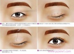 有人去华美做过双眼皮吗,华美割双眼皮怎么样