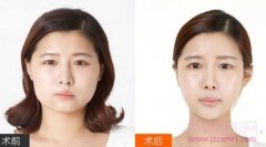 <b>上海华美医院磨骨、削骨专家——李志海</b>