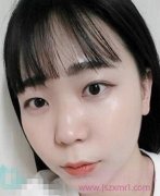 眼部手术+鼻部手术一起做的,看看我是怎么变美哒~