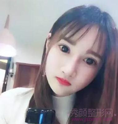 上海华美李志海做的颧弓内推和下颌角,怎么样